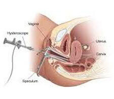 Hysteroscopy