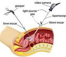 Laparoscopy